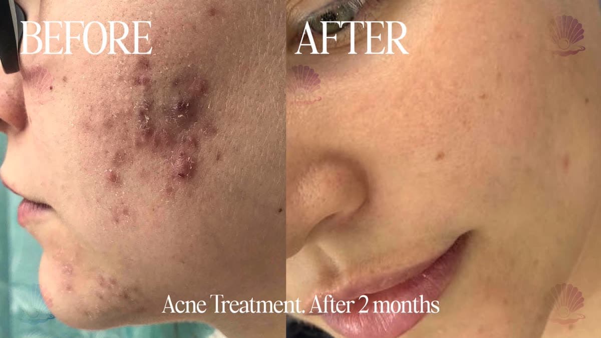 Inflammatory acne