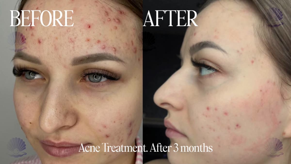 Post-acne marks