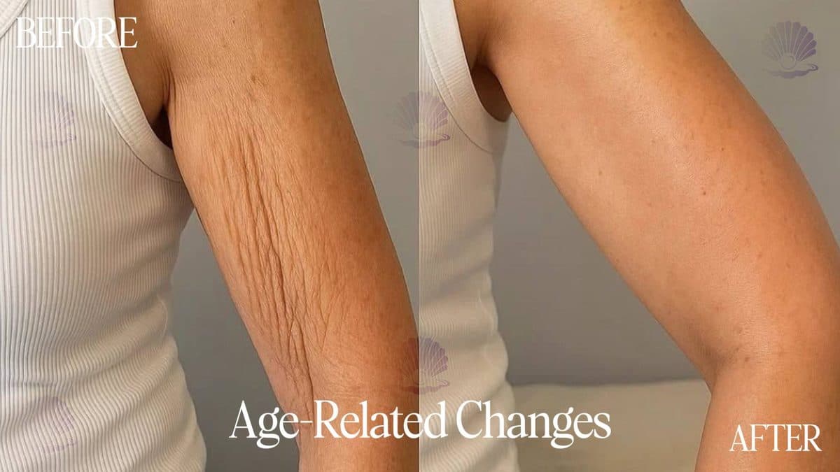 Arm — skin tightened