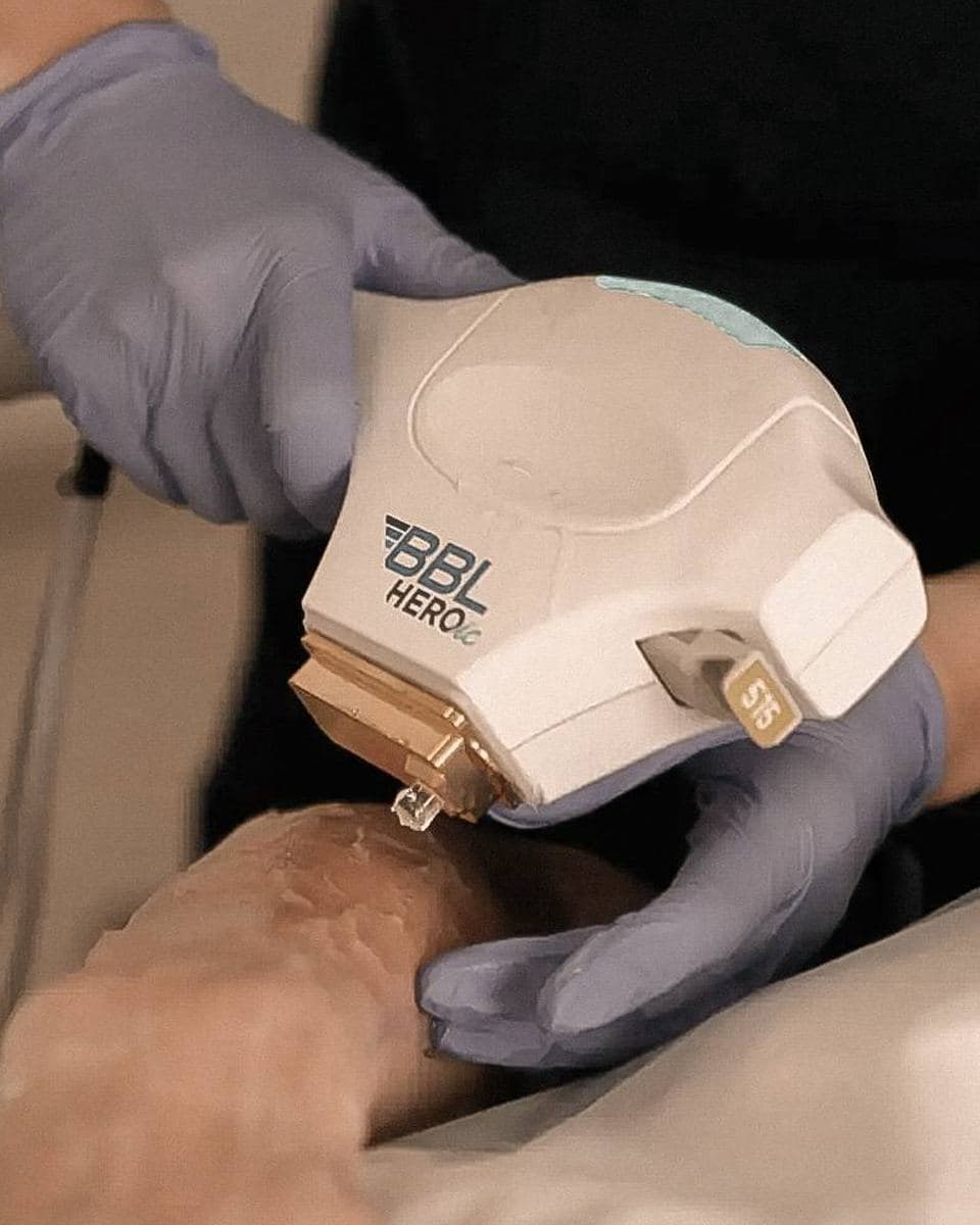 Body Acne treatment approach at Pearl Skin Polyclinic