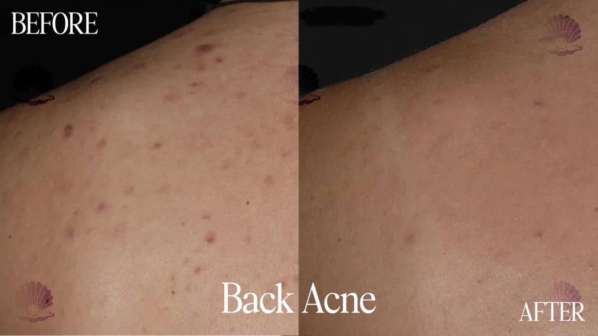 Back — breakout recovery