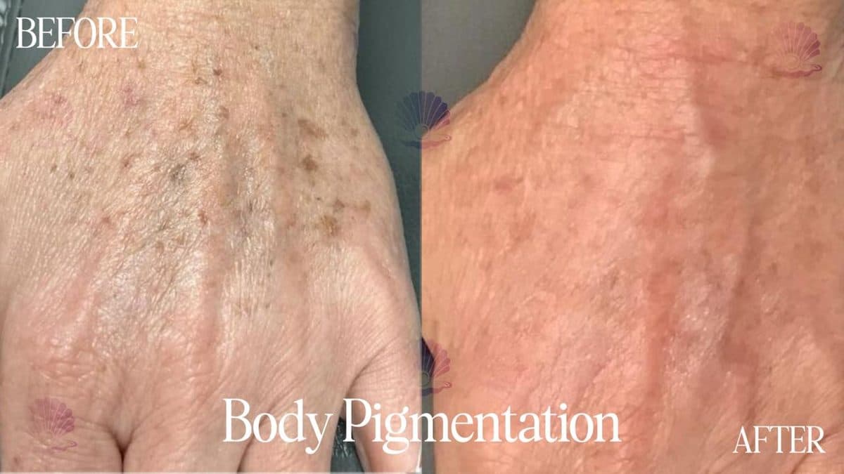 Hand — age spots