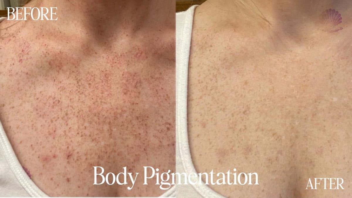 Chest — sun damage