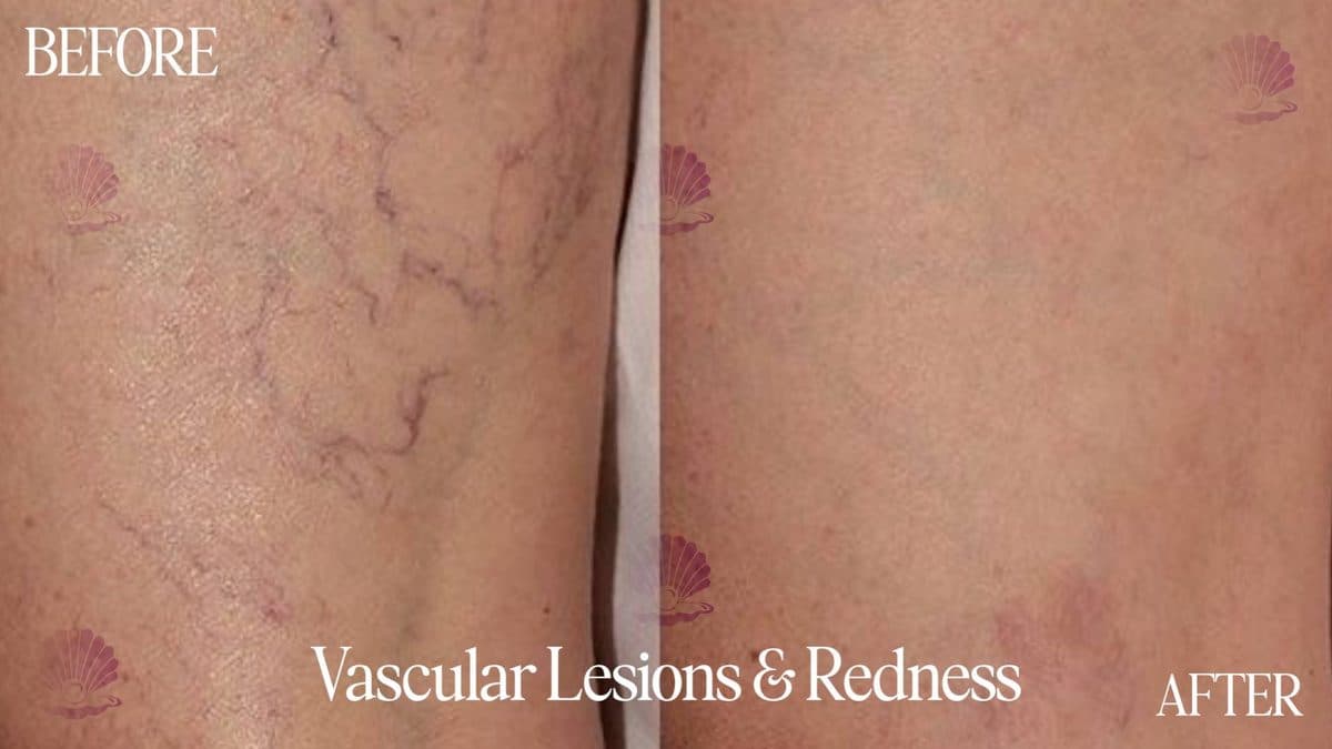 Leg — spider veins