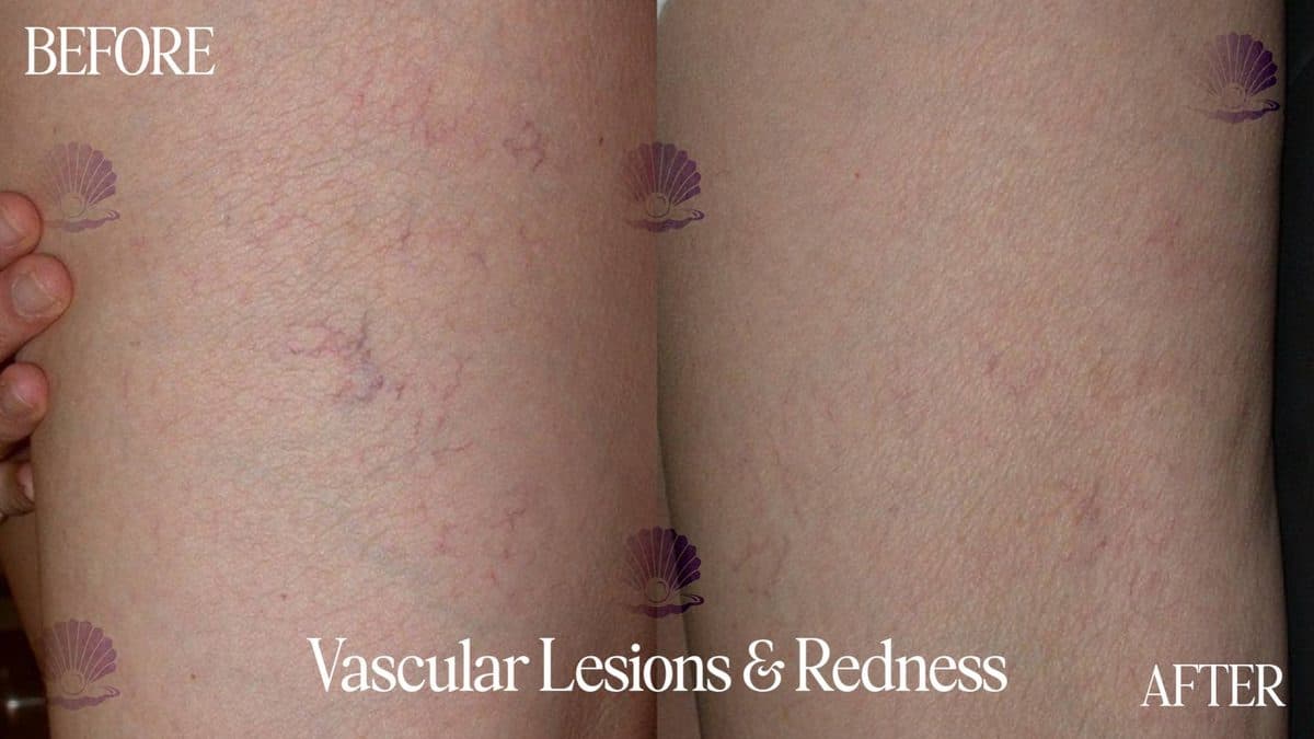 Thigh — broken vessels