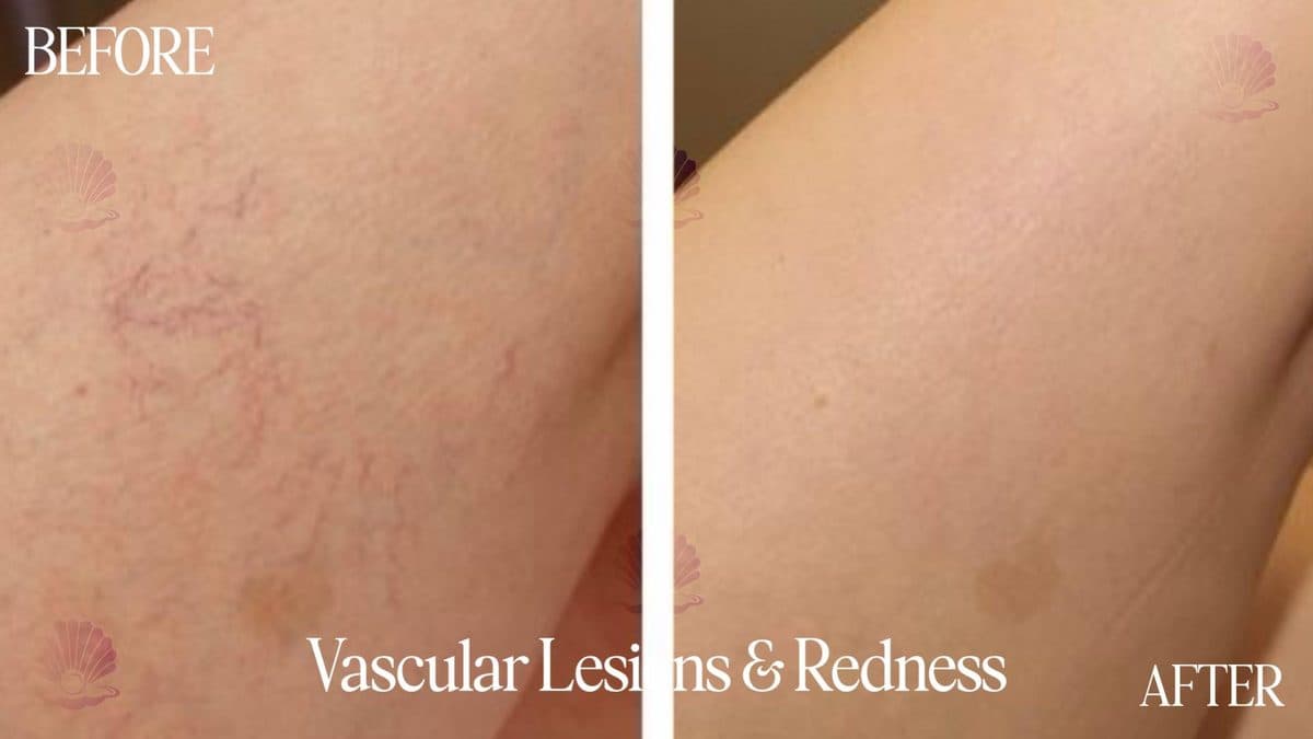 Arm — surface vessels