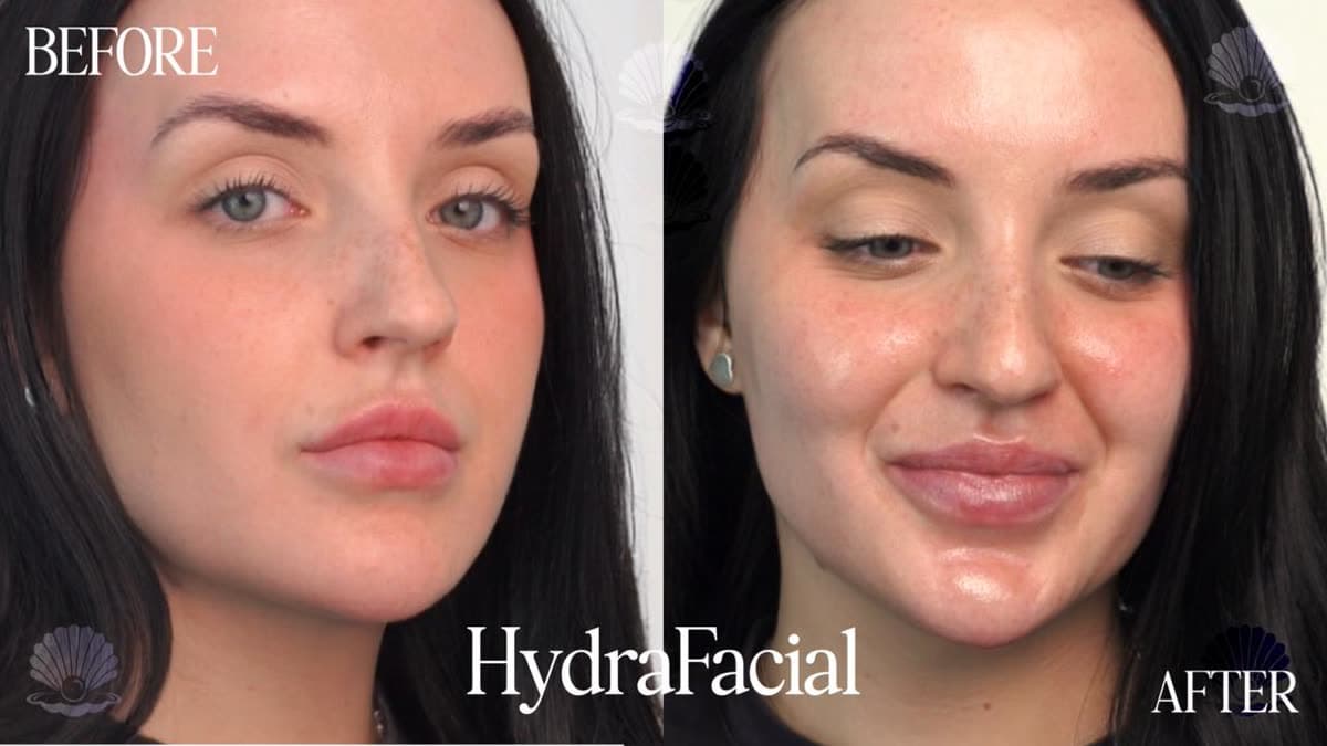 Dehydrated skin