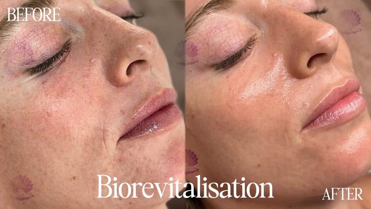 Face — skin quality improved