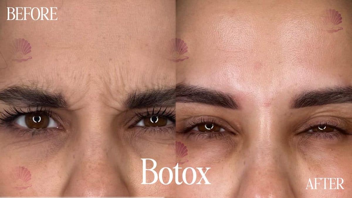 Brow — frown lines softened