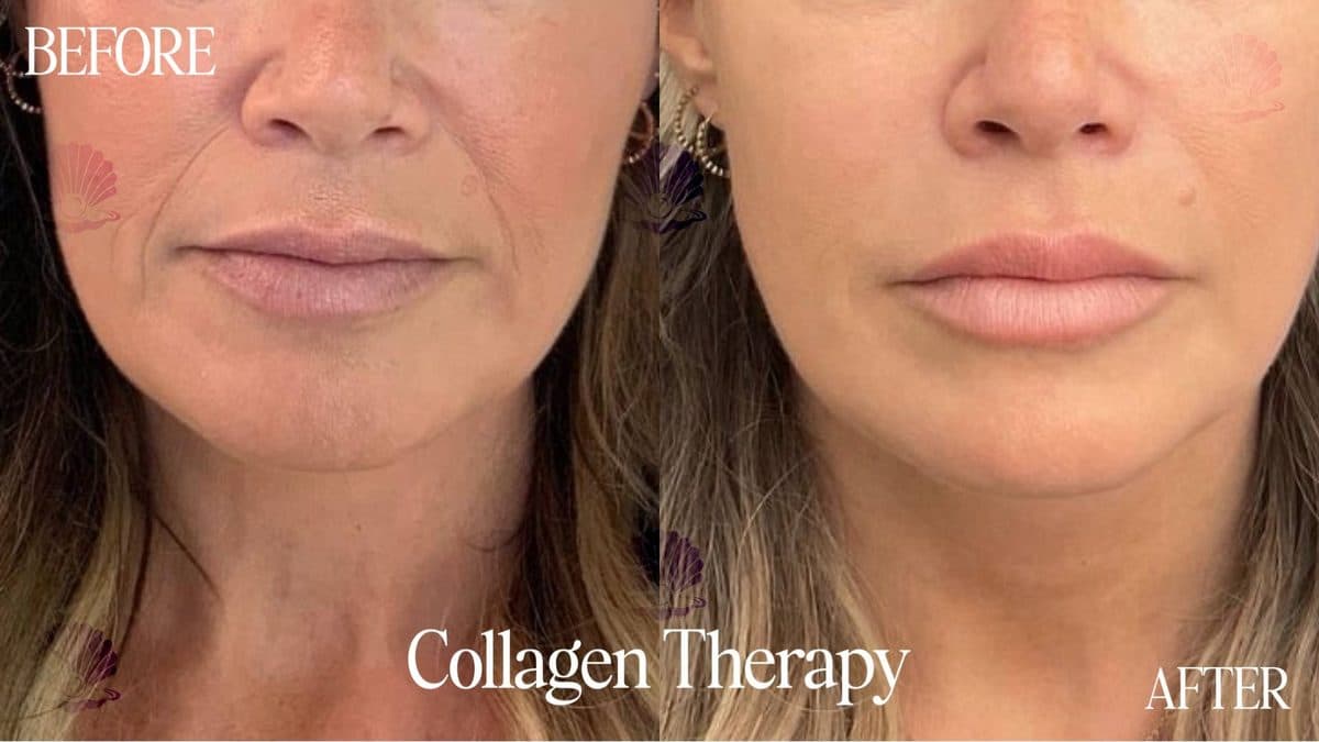 Face — nasolabial lines reduced