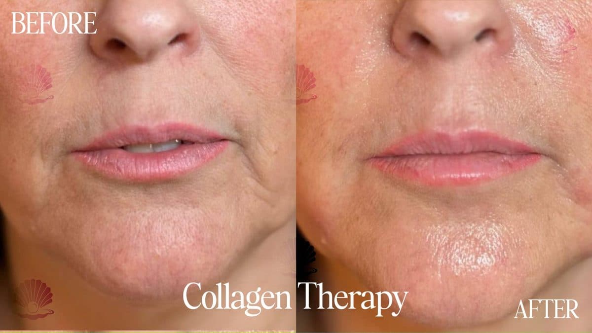 Face — perioral lines softened