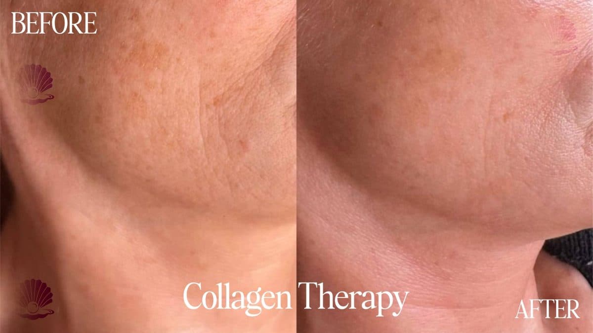 Neck — skin texture improved