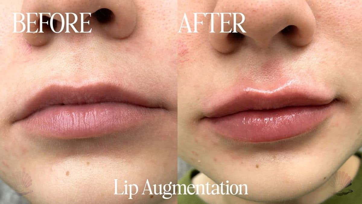 Lips — defined contour