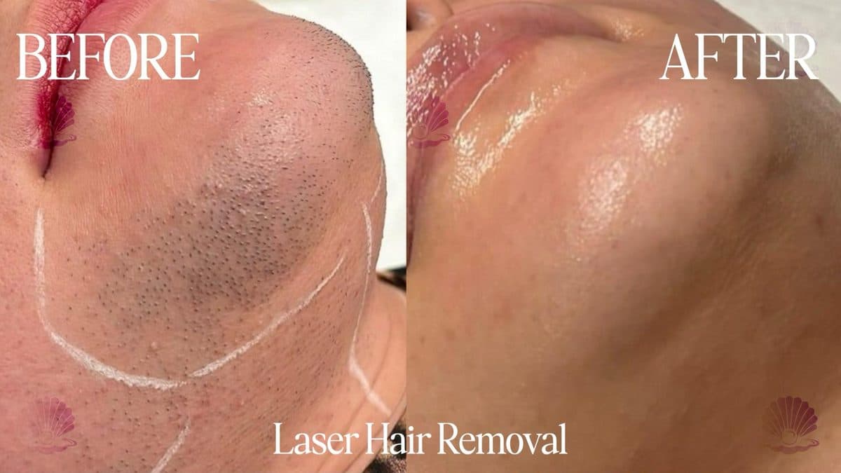 Chin — follicle clearance
