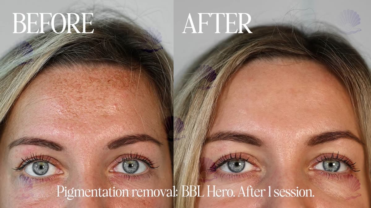 Post-acne pigmentation