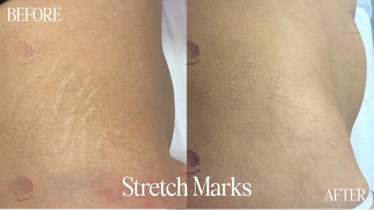 Body — stretch mark reduction